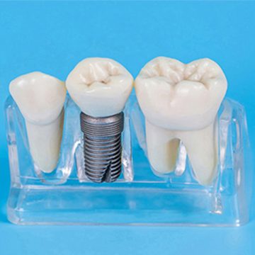 Crown on Front Tooth: Procedure, Types and Aftercare