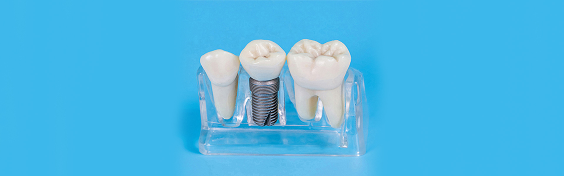 Crown on Front Tooth: Procedure, Types and Aftercare 