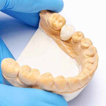 Temporary Crown to Permanent Crown Procedure: What to Expect