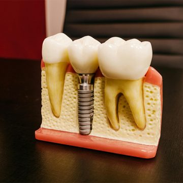 Everything You Need to Know About Dental Implants