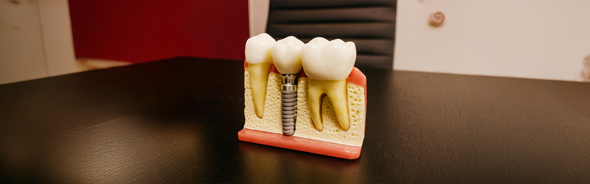 Everything-You-Need-to-Know-About-Dental-Implants