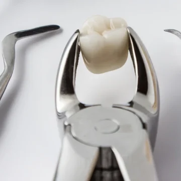 7 Reasons Dentists Recommend Tooth Extraction