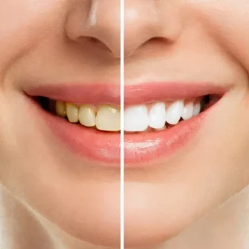 How to Maintain Results After Professional Teeth Whitening